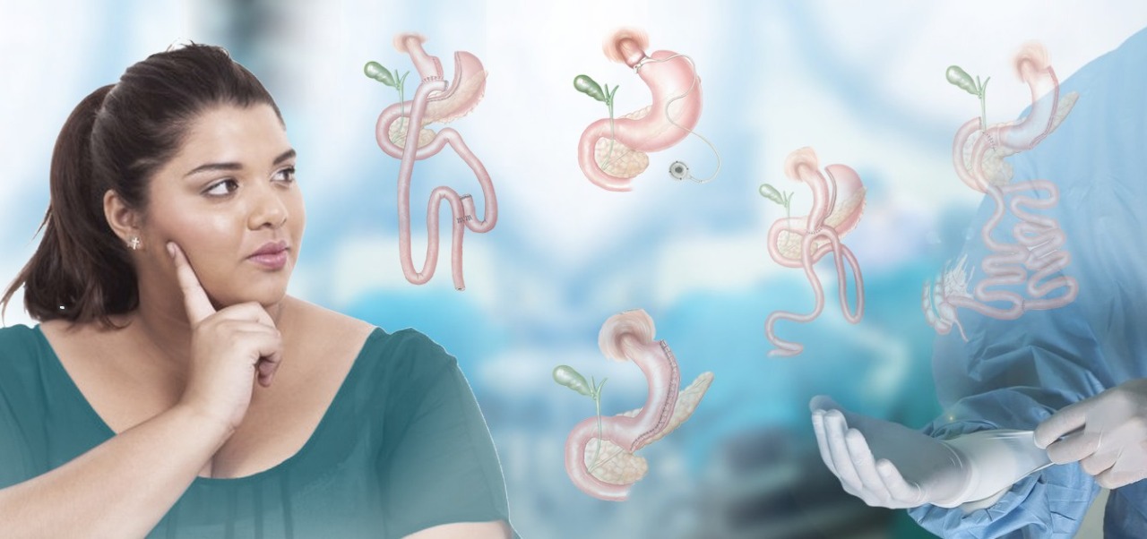 Posso escolher o método da minha bariátrica?