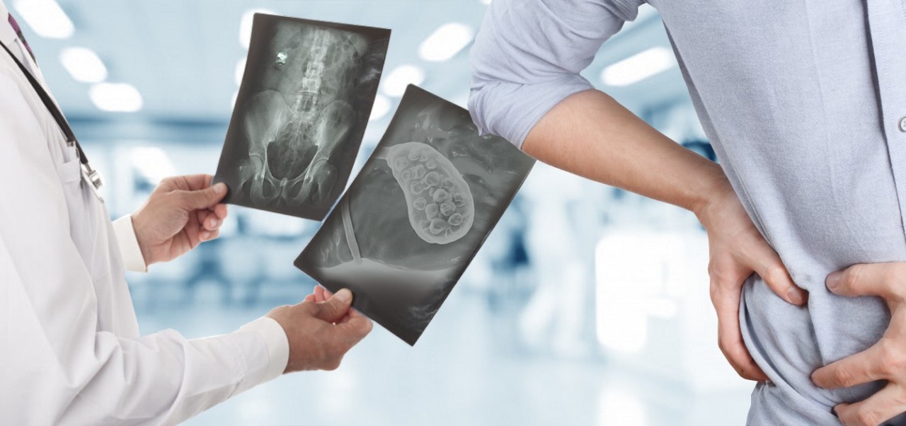 Conheça a Colecistite Aguda