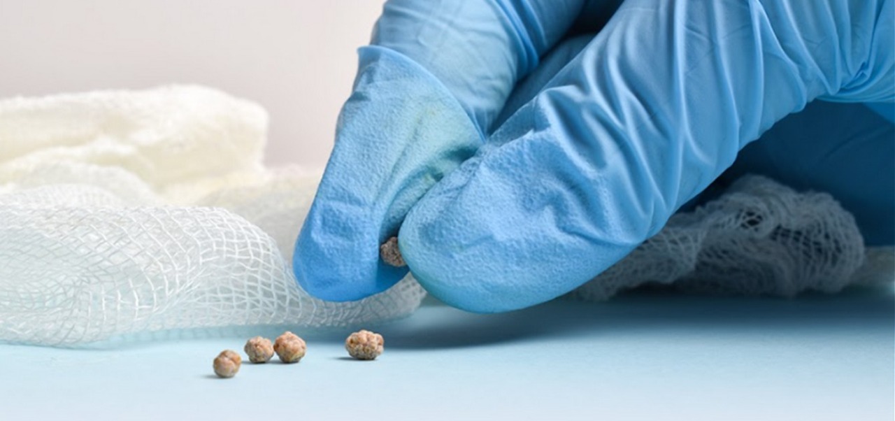 É possível tratar pedra na vesícula sem cirurgia?